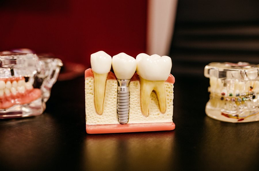 Modelo de implante dentário em titânio, implantologia em Braga