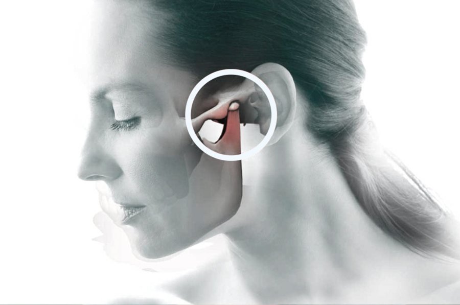 Ilustração da articulação temporomandibular (ATM) junto ao ouvido