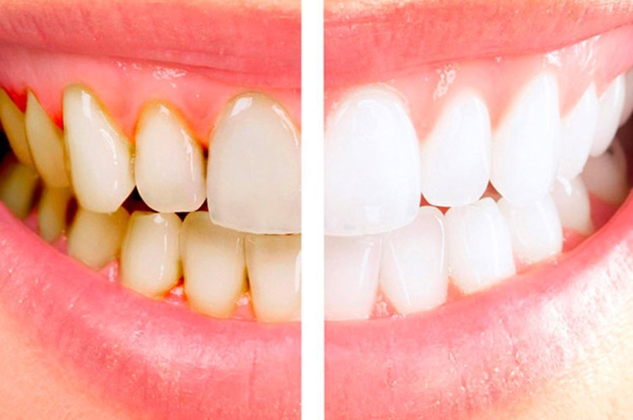 Antes e depois de tratamento das gengivas, periodontia em Braga